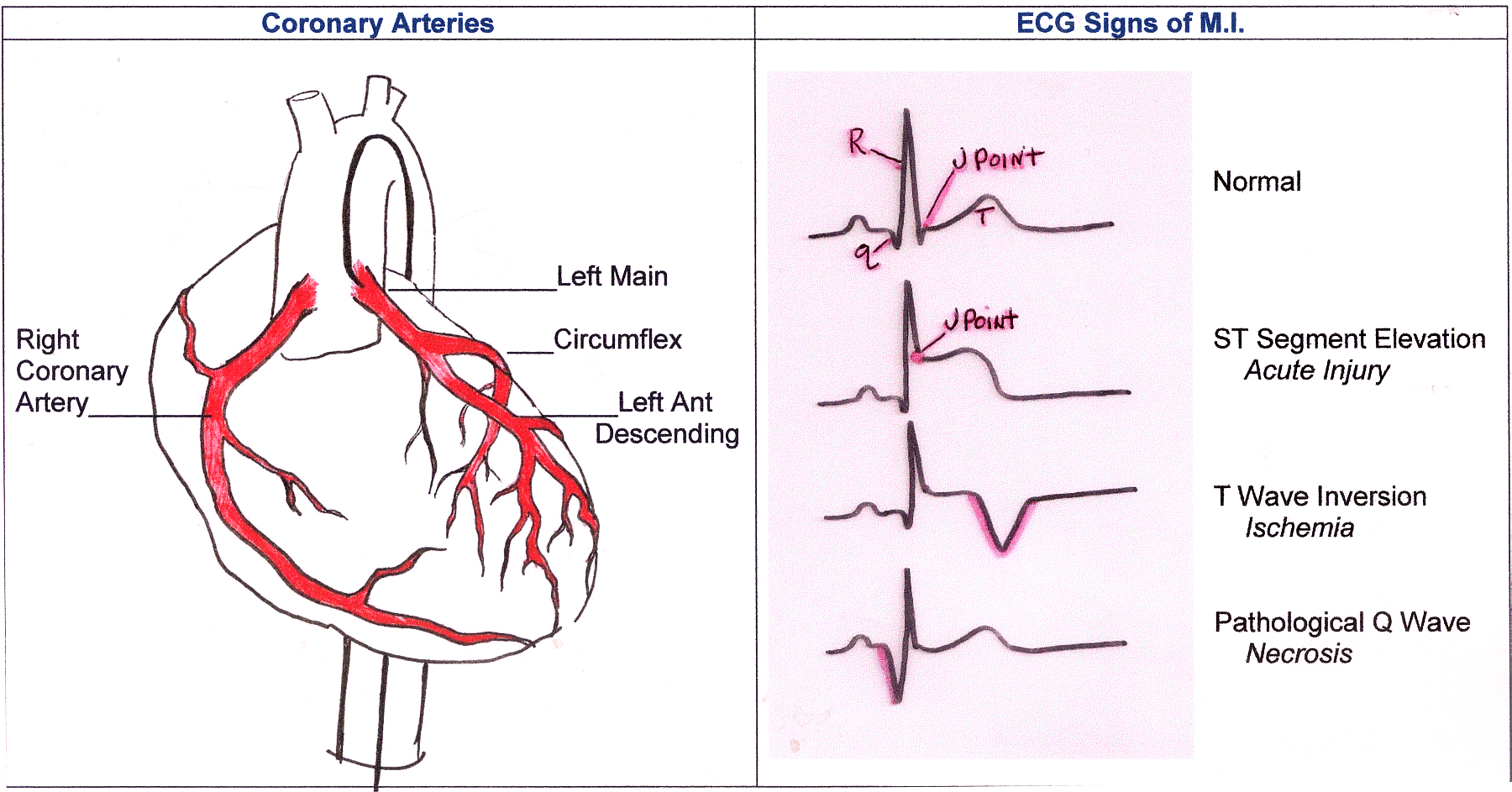 Коронарные артерии на ЭКГ